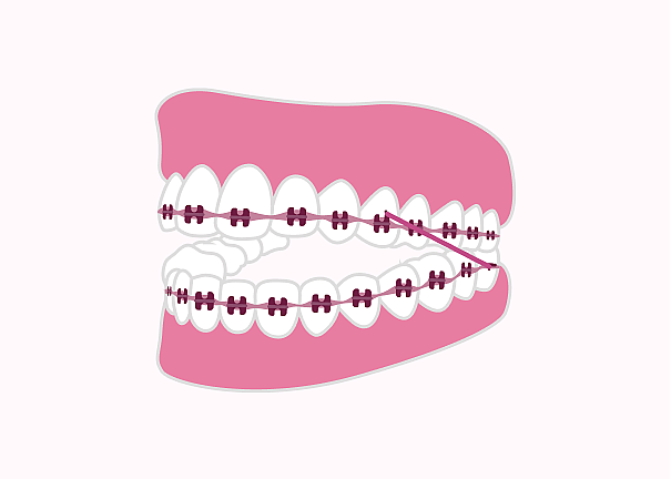 Pink teeth with braces illustration for Atlanta orthodontic website