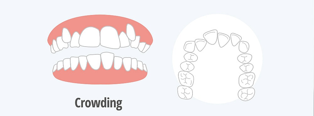 crowding of the mouth