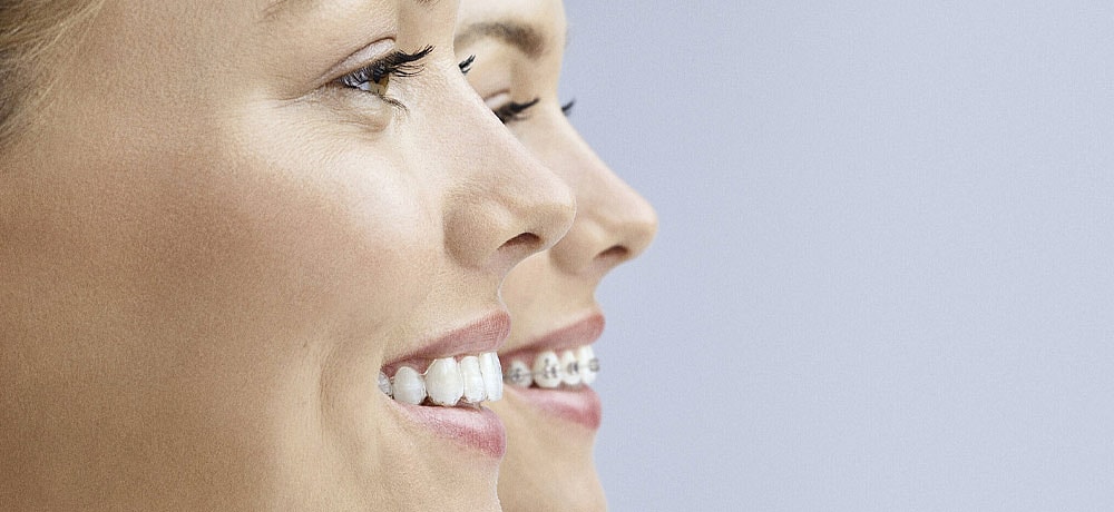 Why Invisalign beats braces for holiday convenience