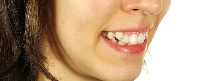 Why do humans have crooked teeth?