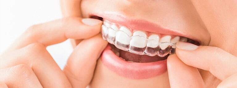Am I too old to get Invisalign?